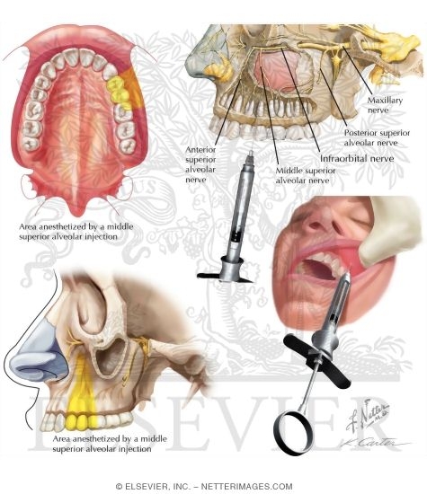 Maxillary Injections: Middle Superior Alveolar Nerve Block