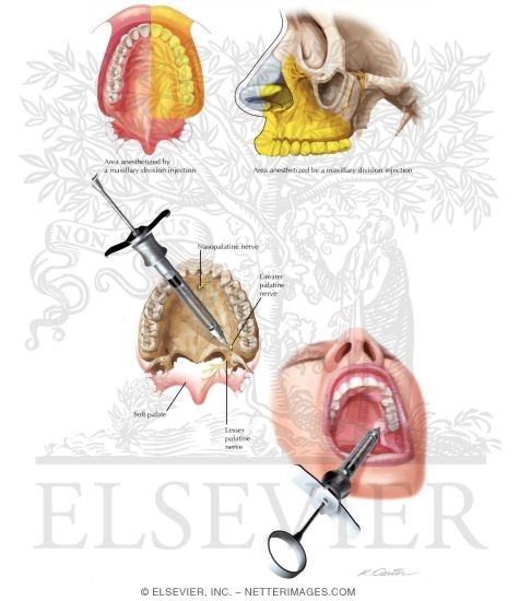 Maxillary Injections: Maxillary Division Block