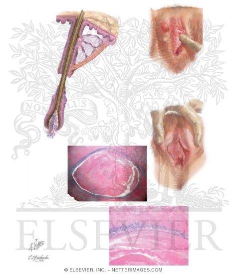Epidermal Inclusion Cyst