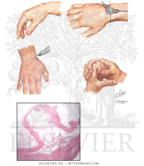 Ganglion Cyst