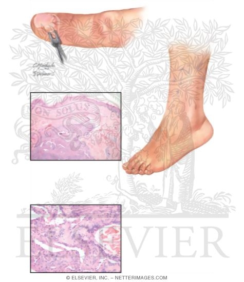 Glomus Tumor and Glomangioma