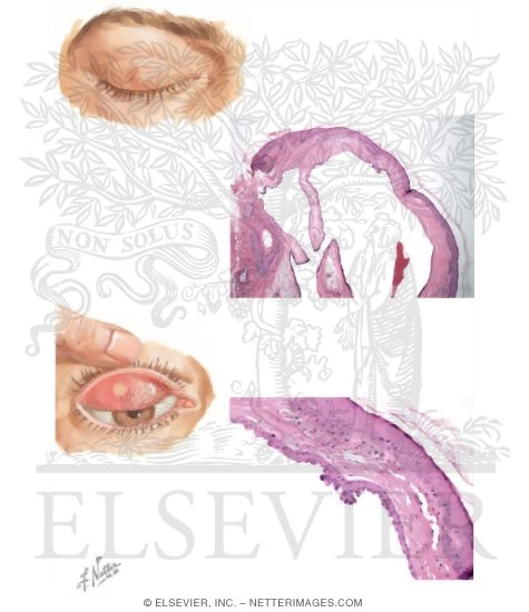 Hidrocystoma