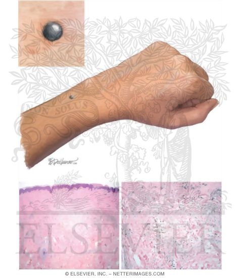 Melanocytic Nevi