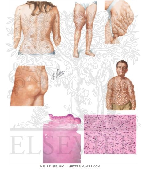 Neurofibroma