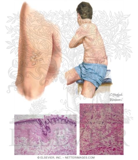 Nevus Lipomatosus Superficialis