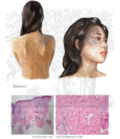 Nevus of Ota and Nevus of Ito