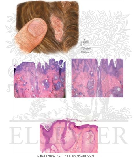 Nevus Sebaceus