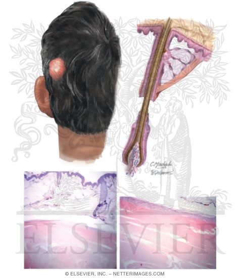 Pilar Cyst (Trichilemmal Cyst)