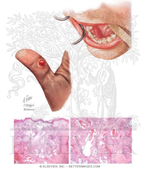 Pyogenic Granuloma