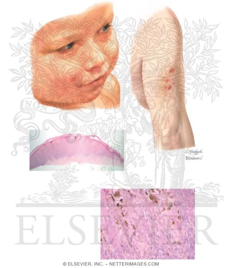 Spitz Nevus
