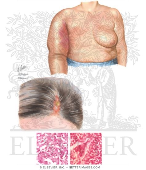 Angiosarcoma
