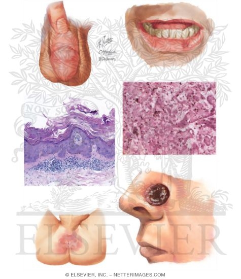 Bowen's Disease