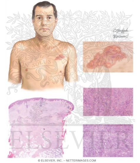 Watermarked preview of unlabeled image: Dermatofibrosarcoma Protuberans