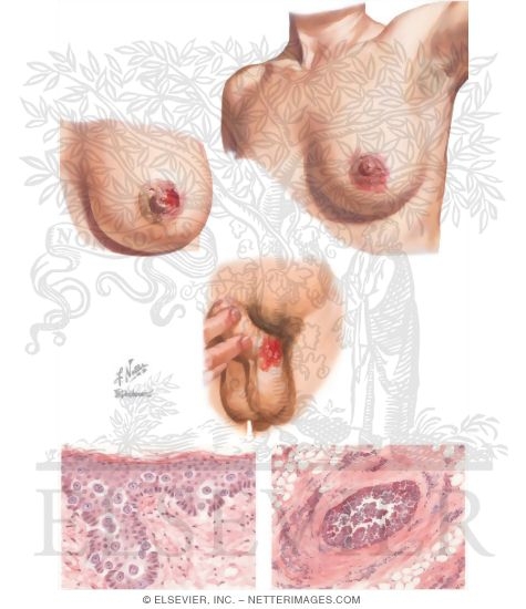 Mammary and Extramammary Paget's Disease