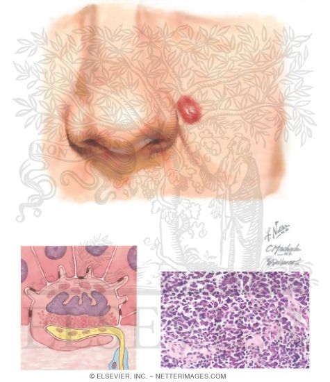 Merkel Cell Carcinoma