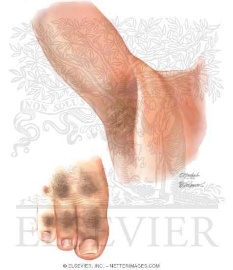 Acanthosis Nigricans