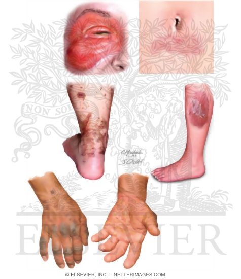 Allergic contact dermatitis pictures skin picture