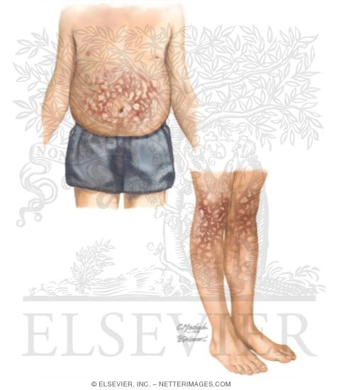 Erythema Ab Igne