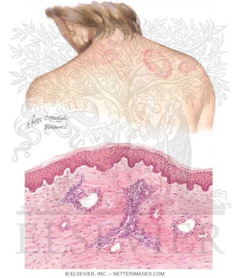 Watermarked preview of unlabeled image: Erythema Annulare Centrifigum