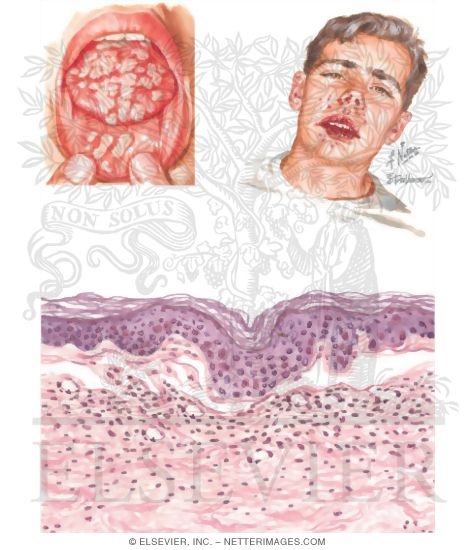 Watermarked preview of unlabeled image: Erythema Multiforme, Stevens-Johnson Syndrome, and Toxic Epridermal Necrolysis