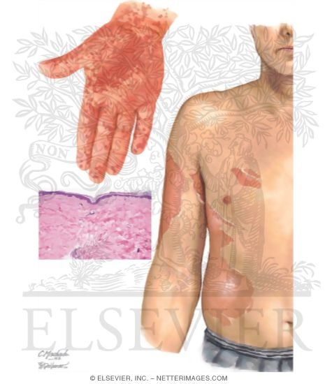 Graft Versus Host Disease