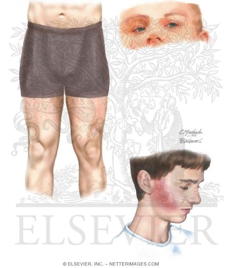 Keratosis Pilaris