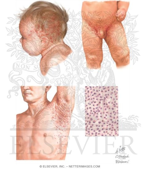 Watermarked preview of unlabeled image: Langerhans Cell Histiocytosis