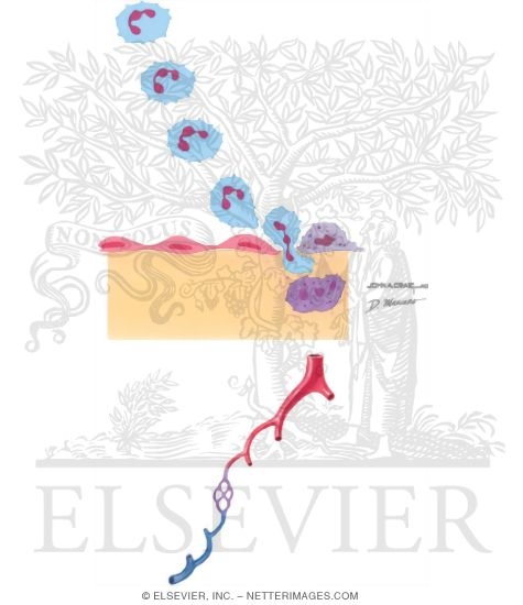Watermarked preview of unlabeled image: Leukocytoclastic Vasculitits