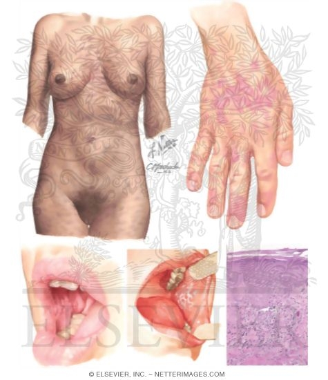 Lichen Planus