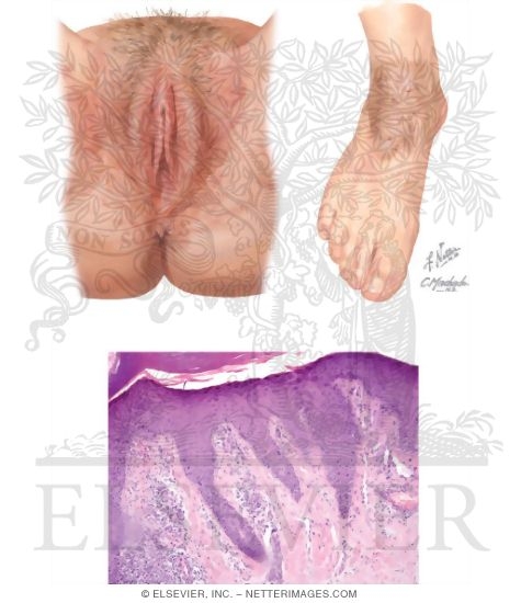 Lichen Simplex Chronicus