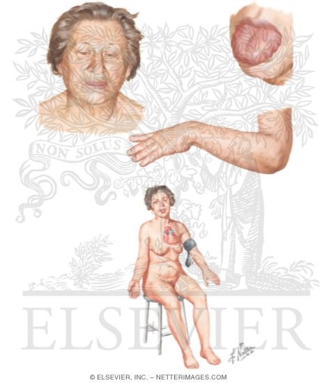 Myxedema