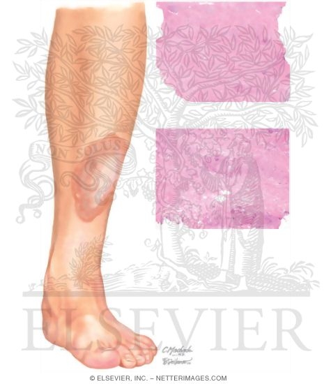 Necrobiosis Lipoidica