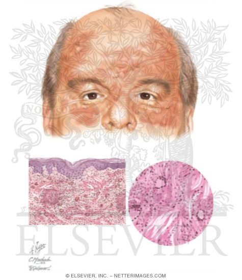 Necrobiotic Xanthogranuloma