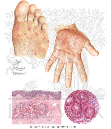 Neutrophilic Eccrine Hidradenitis