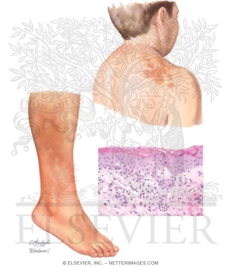 Pigmented Purpura