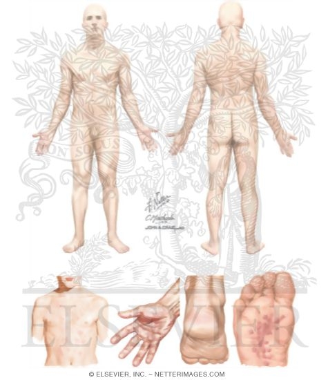 Pityriasis Rosea