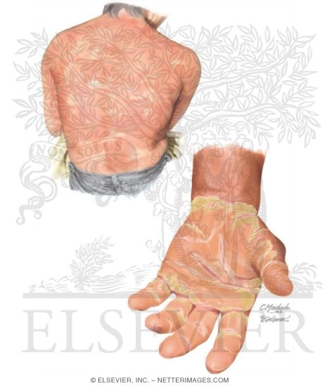 Pityriasis Rubra Pilaris