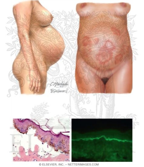 Pruritic Urticarial Papules and Plaques of Pregnancy (PUPPP)