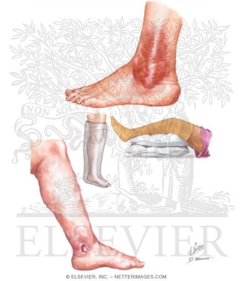 Watermarked preview of unlabeled image: Statis Dermatitis