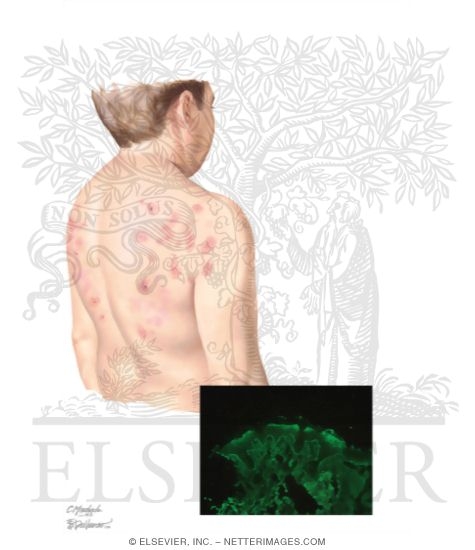 Linear Immunoglobulin A Bullous Dermatosis