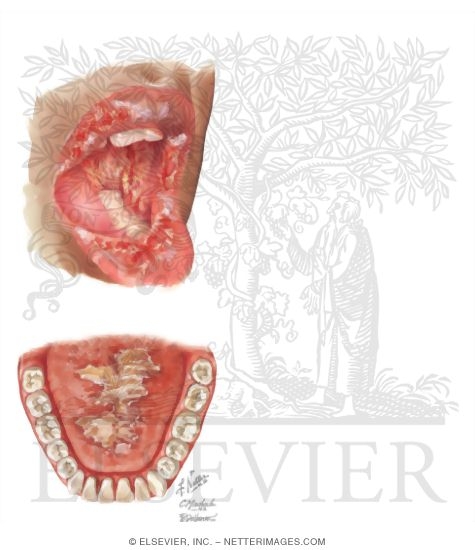 Watermarked preview of unlabeled image: Paraneoplastic Pemphigus