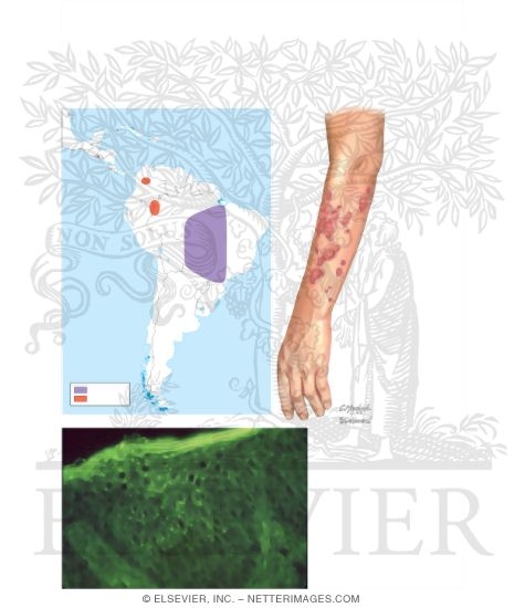 Pemphigus Foliaceous
