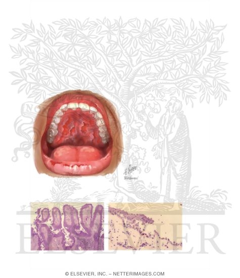 Pemphigus Vulgaris