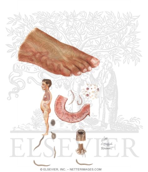 Cutaneous Larva Migrans