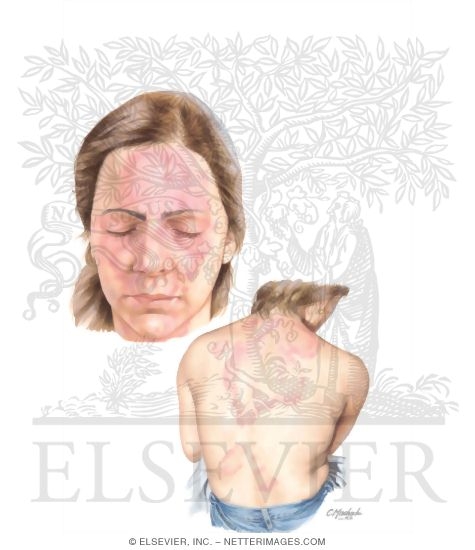 Dermatophytoses