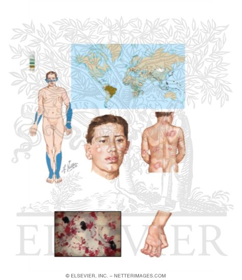 Watermarked preview of unlabeled image: Leprosy (Hansen's Disease)