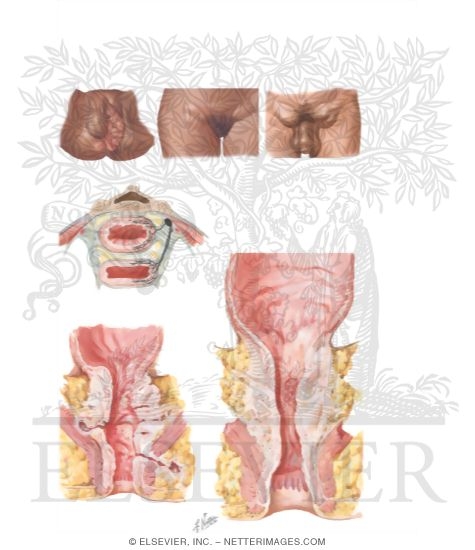 Lymphogranuloma Venereum