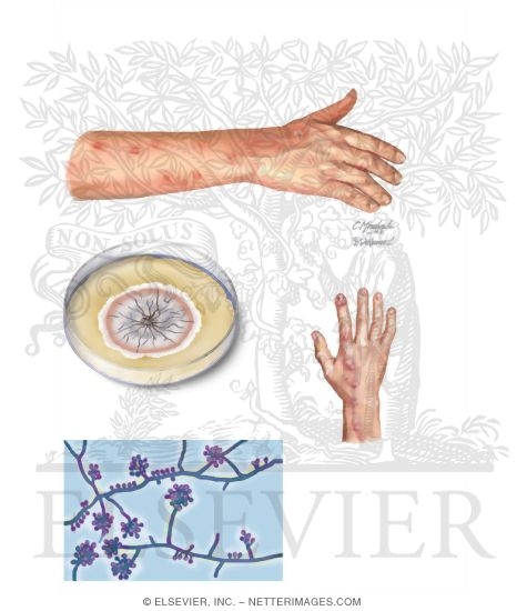 Sporotrichosis