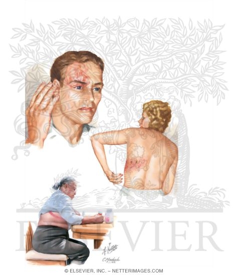 Herpes Zoster (Shingles)