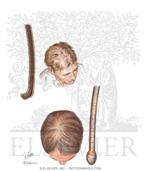 Watermarked preview of unlabeled image: Telogen Effluvium and Anagen Effluvium